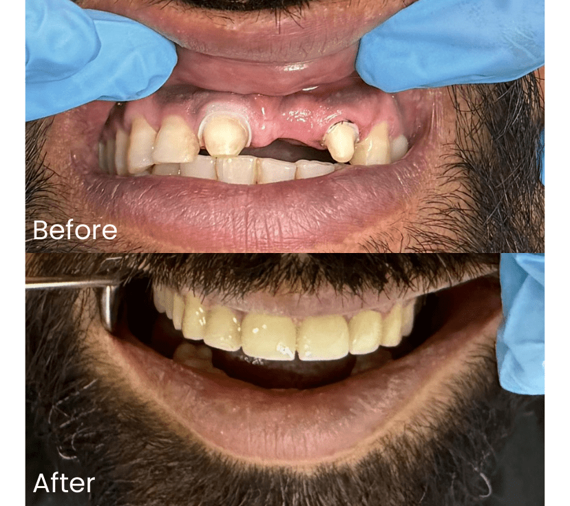 Reference case from Smile Avenue showing teeth before and after treatment