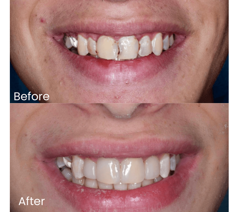 Second reference case from Smile Avenue comparing front teeth before and after treatment