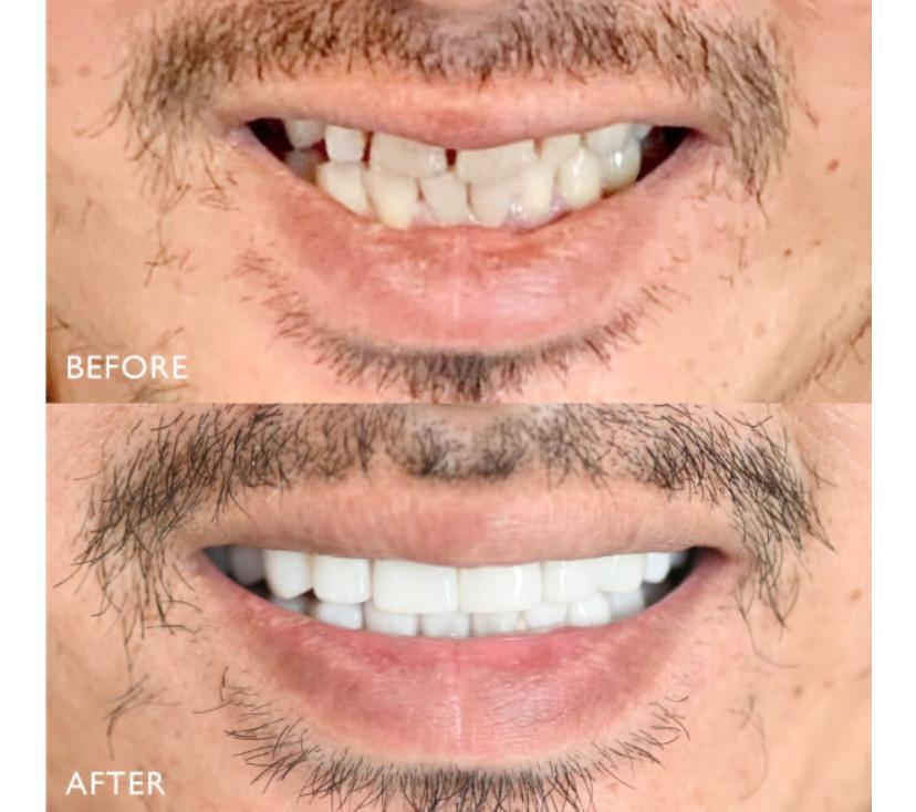 Third reference case from Smile Avenue showing a smile before and after treatment